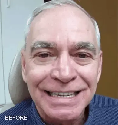 Before and after denture treatment results