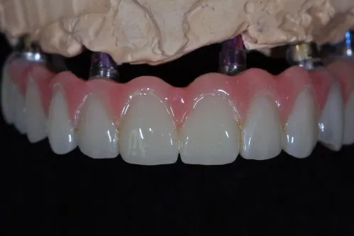 Dental implants in a model