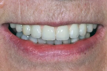 Smile restored with implant dentures