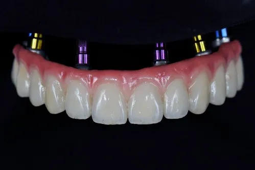 Dental implants supporting a denture