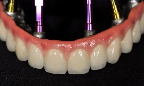 Implant dentures