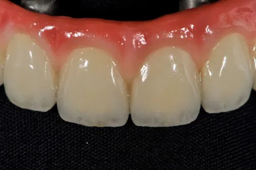 Implant denture close-up