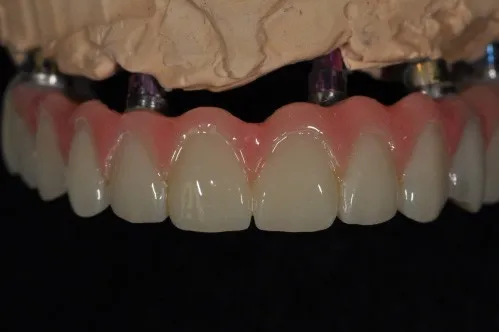 Implant dentures in a model
