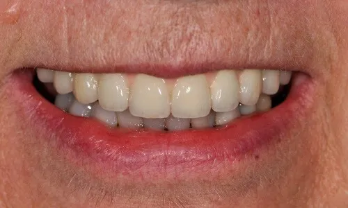 Implant dentures in a mouth