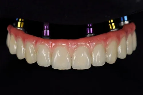 Implant dentures