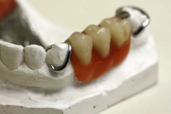 Partial dentures being molded