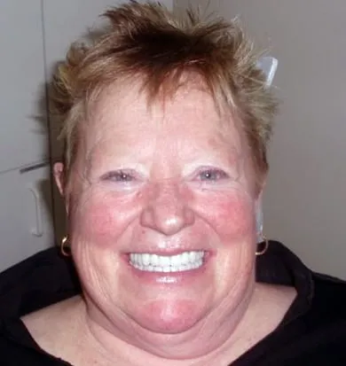 Smile after denture treatment, example 3