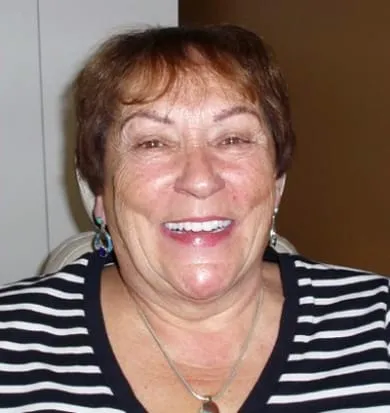 Smile after denture treatment, example 4