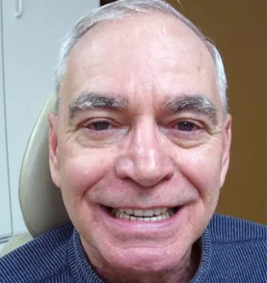 Smile before denture treatment, example 2