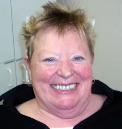 Smile before denture treatment, example 3