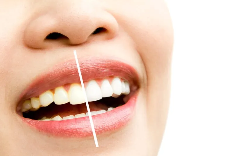 Yellow stained teeth turning white