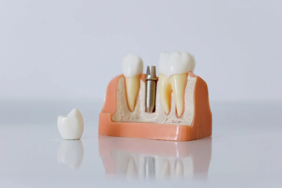 implant supported bridges