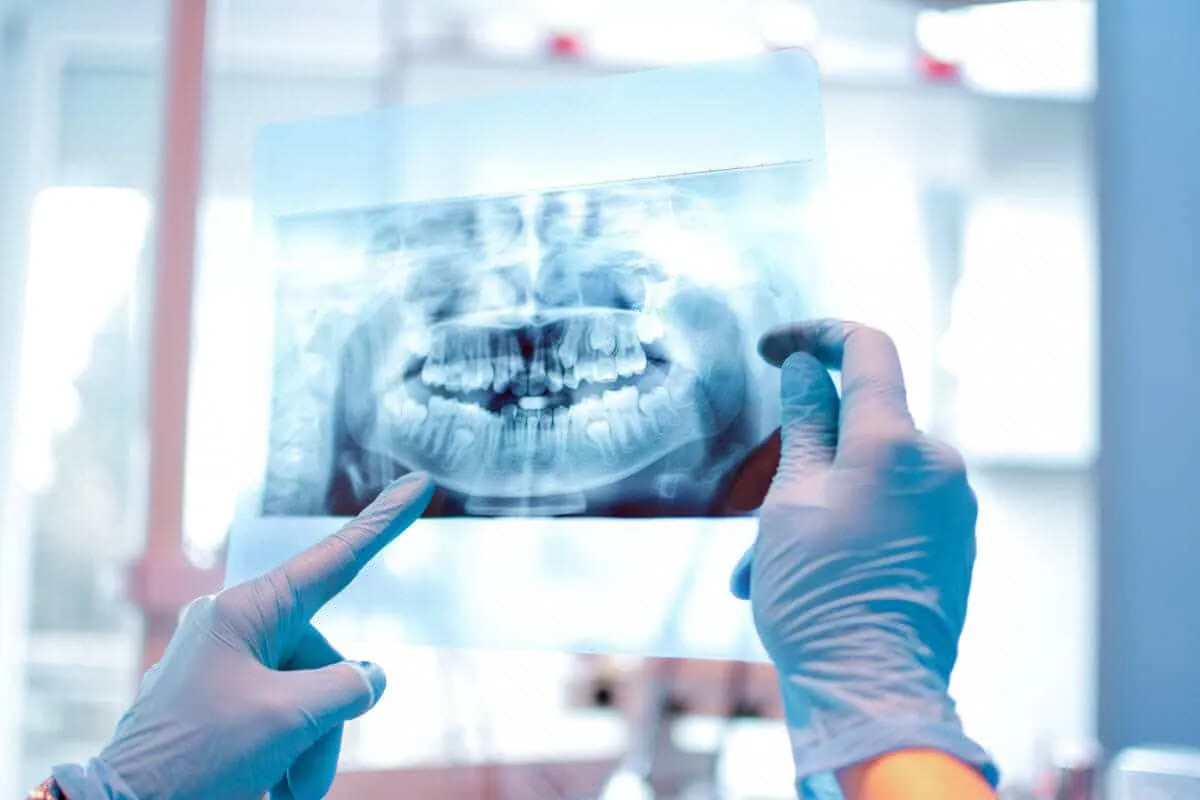 Missing Tooth Replacement