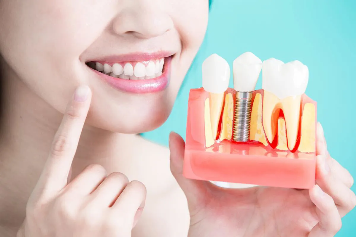 All on X Dental Implants
