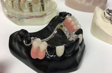 Dental vs Partial Dentures